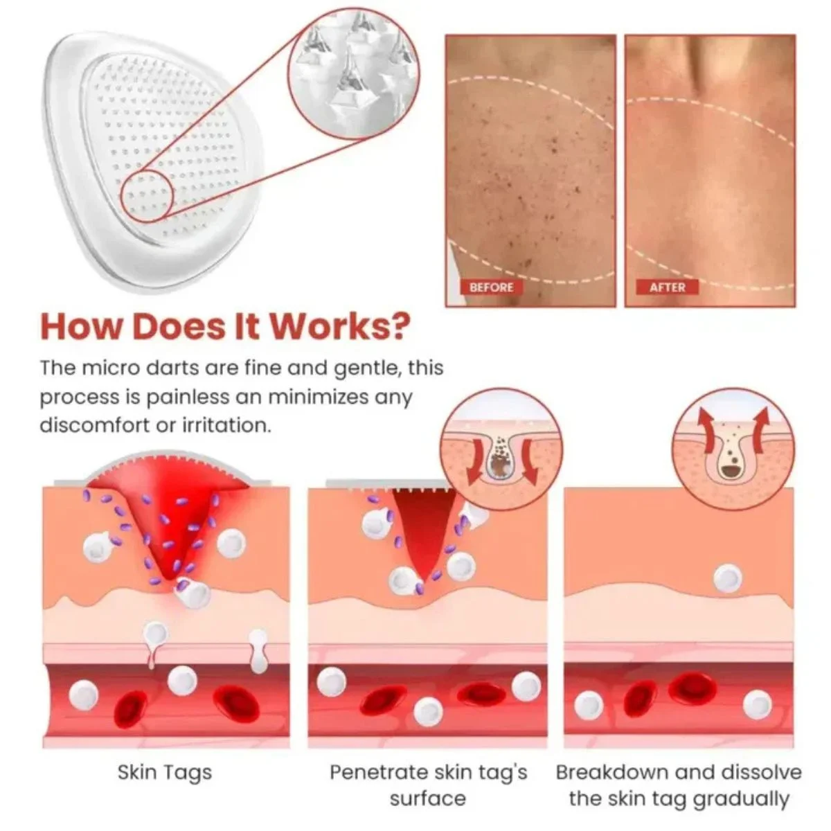 DermaSmooth Skin Tag Remover Patch | Fast, Safe & Painless Skin Tag & Mole Removal | Nano-Microneedle Technology | 72 Patches - Image 4