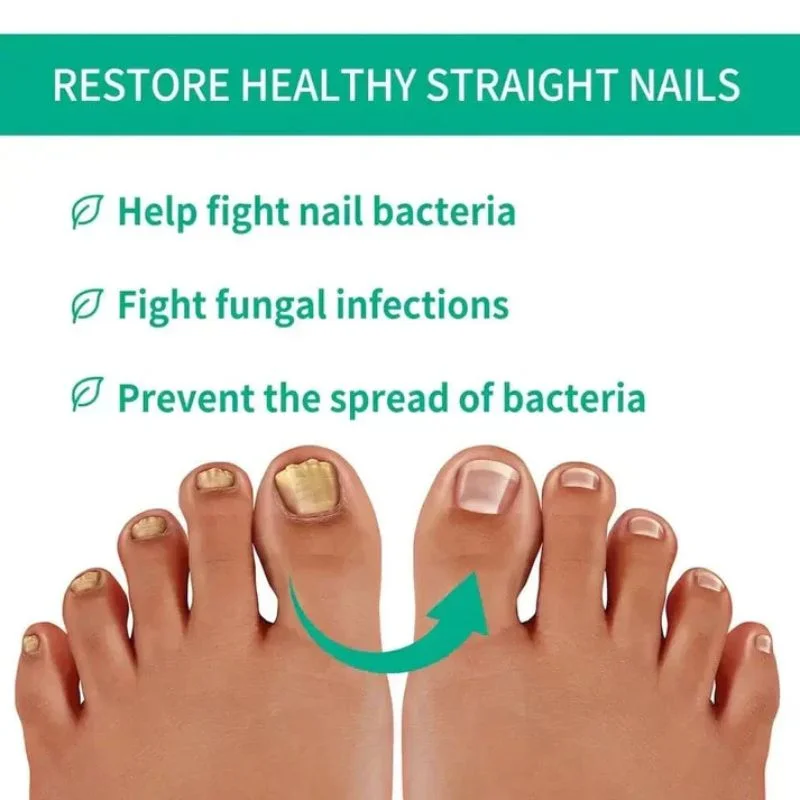 Fast Nail Fungus Treatment Serum | Nail Repair Essence for Fingernails & Toenails | Natural Nail Care Formula - Image 6