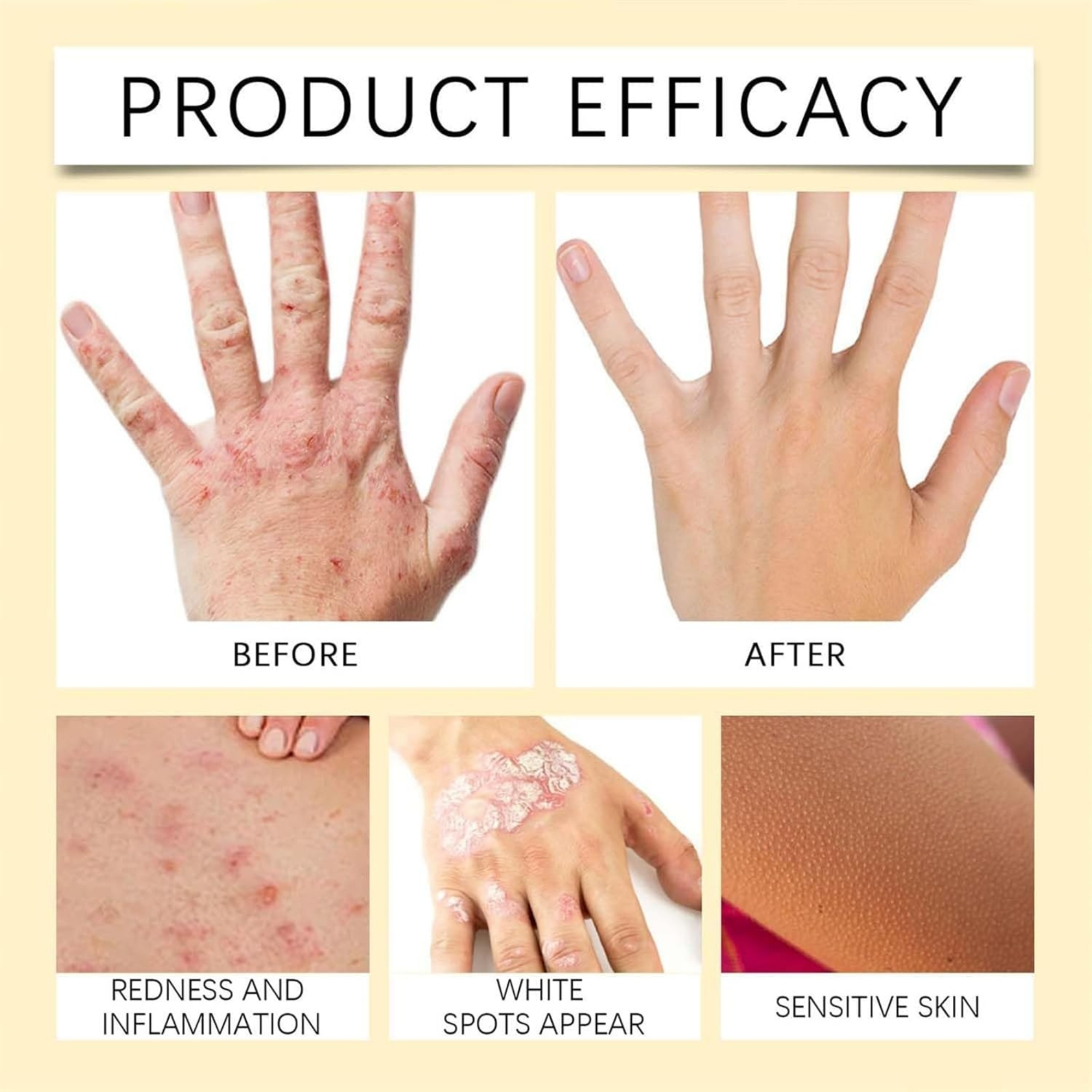 Vitigo Bee Venom Treatment Cream | Natural Skin Repair Hydration Relief Anti-Irritation - Image 8